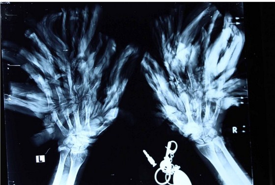图上是树人兄的双手X光(X-Ray)-红安洗眼器资讯（来源：CNN.com）
